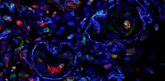 Circulating Immune Cells as Biomarkers for Idiopathic Pulmonary Fibrosis